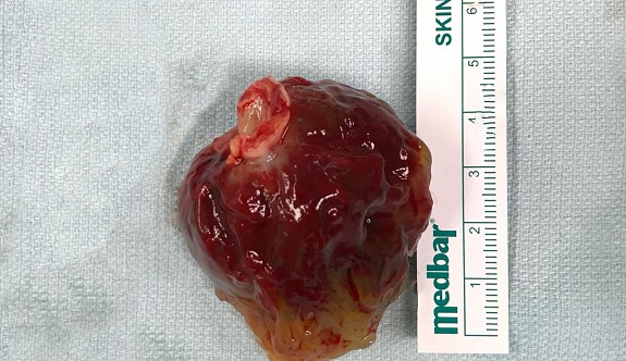Kalbinden 5cm’lik tümör çıkarıldı