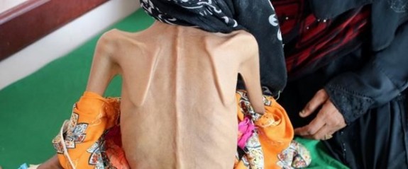 10 kg ağırlığındaki Yemenli kız tedavi altına alındı