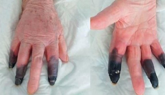 Corona virüsü hastasının parmakları kesildi