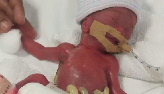 'Dünyanın en küçük bebeği' 13 aylık tedavinin ardından hastaneden taburcu oldu