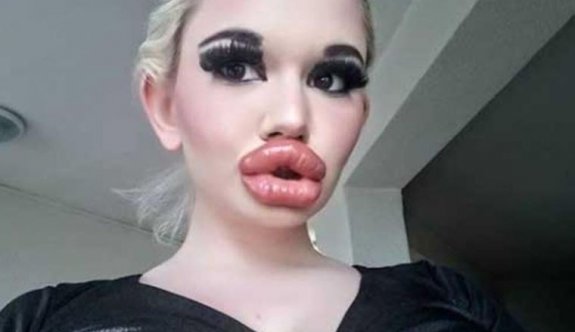 Dünyanın en büyük dudaklı' kadını, 27. estetik operasyonuna hazırlanıyor